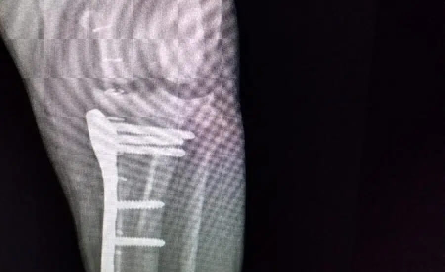 Fracture Repair